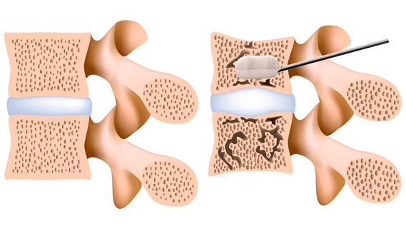 vertebroplast2.jpg