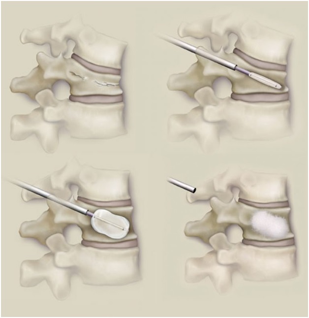 vertebroplast3.jpg