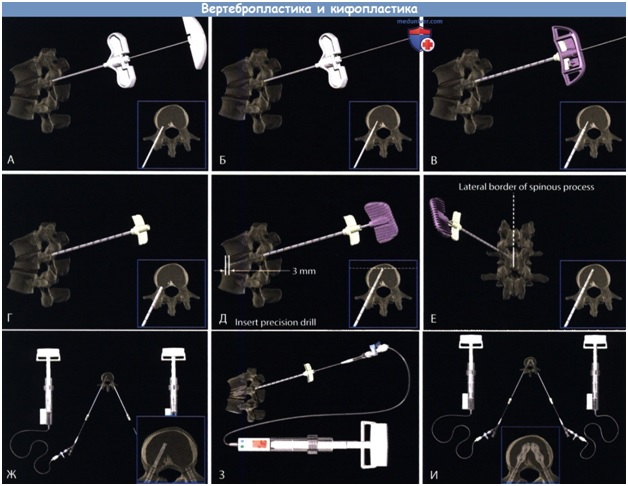 vertebroplast5.jpg