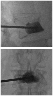 vertebroplast6.jpg